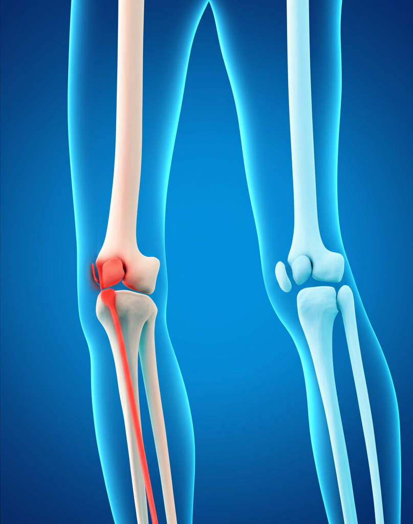 Paget hastalığının radyolojik bulguları nasıldır? 